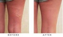 Reticular Varicose Before After