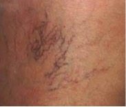 Spider Vein 1