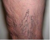 Spider Vein 3