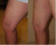 Spider Veins Before After
