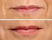 Restylane Silk