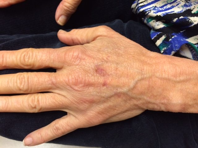 Hands Before Radiesse Injectable Filler Hands Before Radiesse Injectable Filler