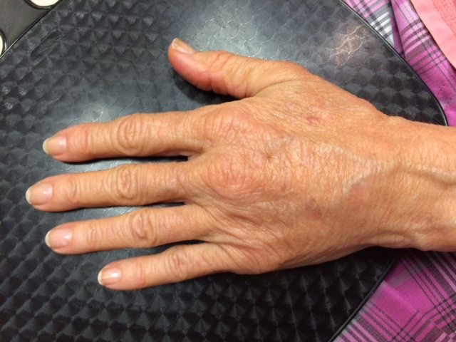 Hands After Radiesse Injectable Filler Treatment Hands After Radiesse Injectable Filler Treatment