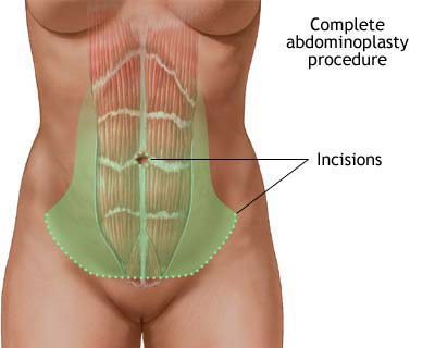tummy tuck abs