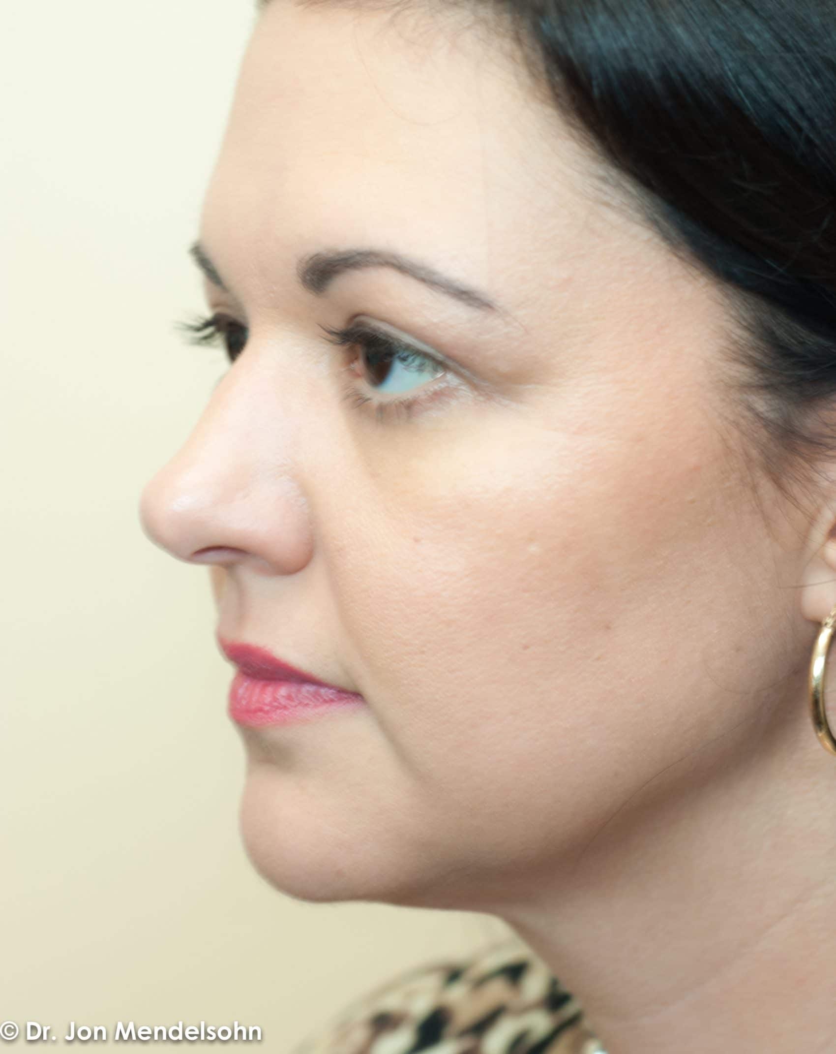 Upper-blepharoplasty-eyelid-surgery-cincinnati-dr-jon-mendelsohn-best-eyelid-surgery-plastic-surgery-realself-truseselfies-three-quarter-left-after-Mahan_Crystal-3924-2